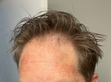 men's before image of thinning hair