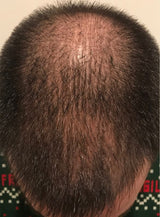 male before picture showing thinning hair