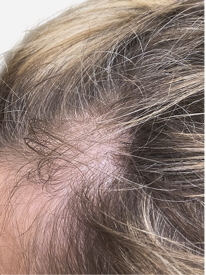 Close-up of women's fine, thinning hair near the temple with visible scalp and reduced hair fullness before Zenagen Revolve shampoo and conditioner.