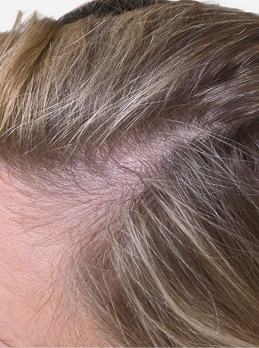 Close-up of women's hair at the temple showing fuller-looking strands and improved appearance of hair density after using Zenagen Revolve hair care.