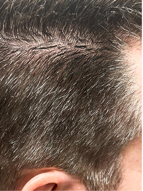 Close-up of men's salt-and-pepper hair with visible gray strands at the temples before Zenagen Eclipse gray hair care shampoo.