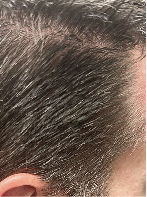 Close-up of men's darker-looking salt-and-pepper hair with less prominent gray strands after using Zenagen Eclipse shampoo for natural hair color preservation.