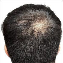 Before photo showing visible thinning at the crown area with increased scalp visibility on the vertex of the head.