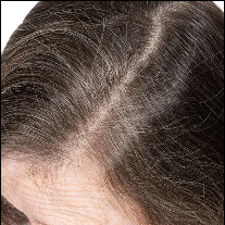 Before photo of a widened hair part with visible scalp showing through fine, thinning hair.