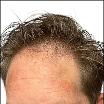 Before photo of a receding hairline with visible thinning across the frontal scalp and temple areas.