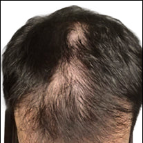 Before photo showing diffuse thinning on the top of the scalp with visible scalp exposure through dark hair.