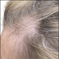 Before photo showing visible hair thinning along the hairline and temple area prior to using a hair care routine for fine and thinning hair.