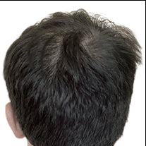 After photo showing fuller-looking hair coverage at the crown with reduced scalp visibility and improved appearance of density.