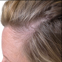 After photo showing the appearance of fuller-looking hair coverage and improved density along the hairline and temple area.