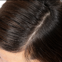 After photo showing the appearance of a narrower hair part and fuller-looking hair along the scalp line.