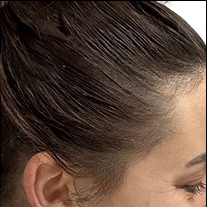 After photo showing the appearance of increased hair coverage and denser-looking hair around the temple and hairline.