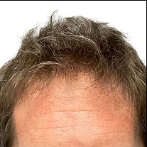 After photo showing the appearance of fuller-looking hair along the frontal hairline with improved coverage across the forehead area.