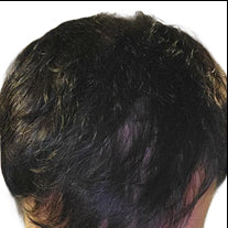 After photo showing denser-looking hair coverage on the top of the scalp with less visible scalp showing through.