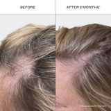 Before and after comparison of hair growth treatment on a person's scalp.