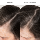 Before and after comparison of hairline treatment showing a line of gray hair on a person's forehead.