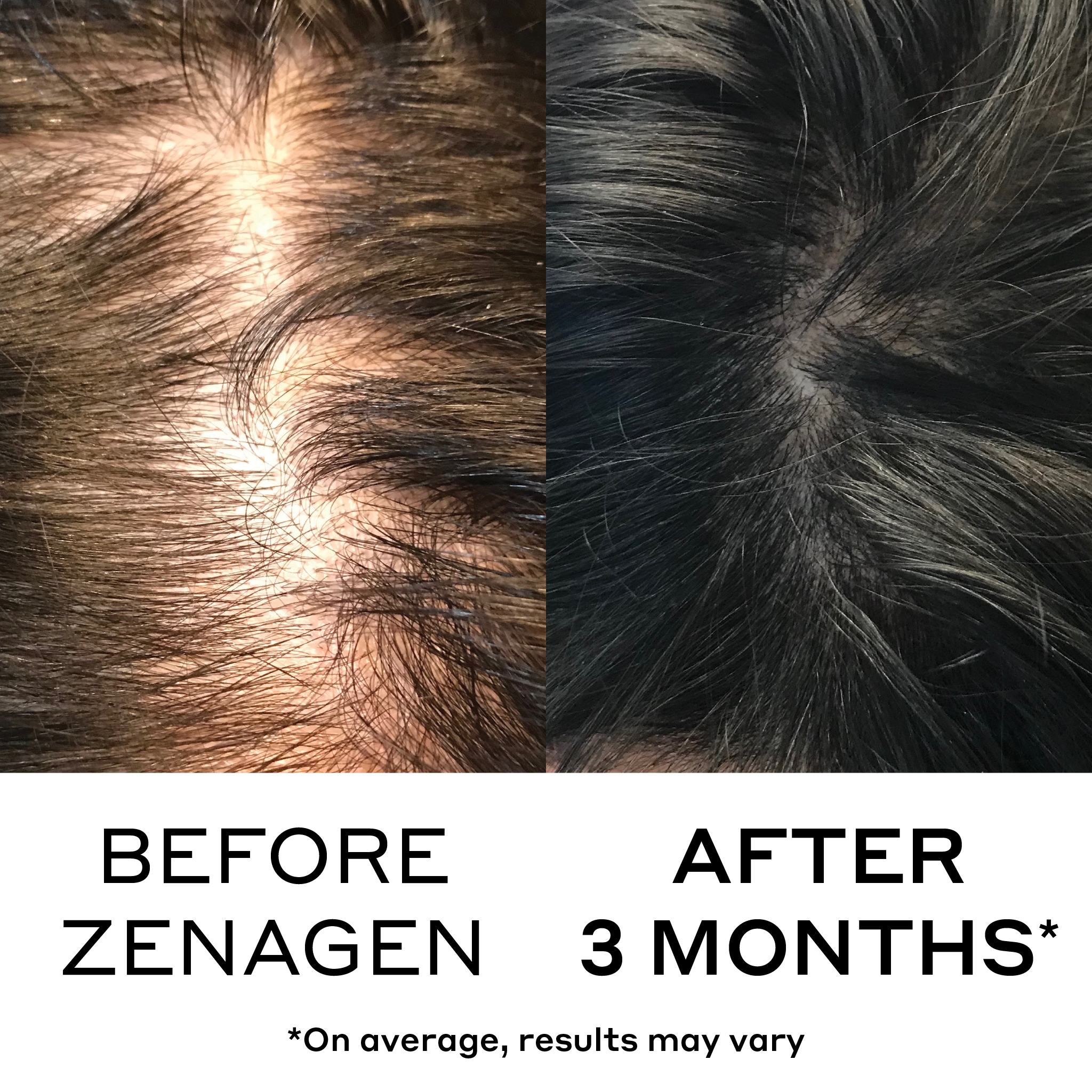 before and after showing reduced hair loss and thinning due to three months of zenagen densifying hair serum