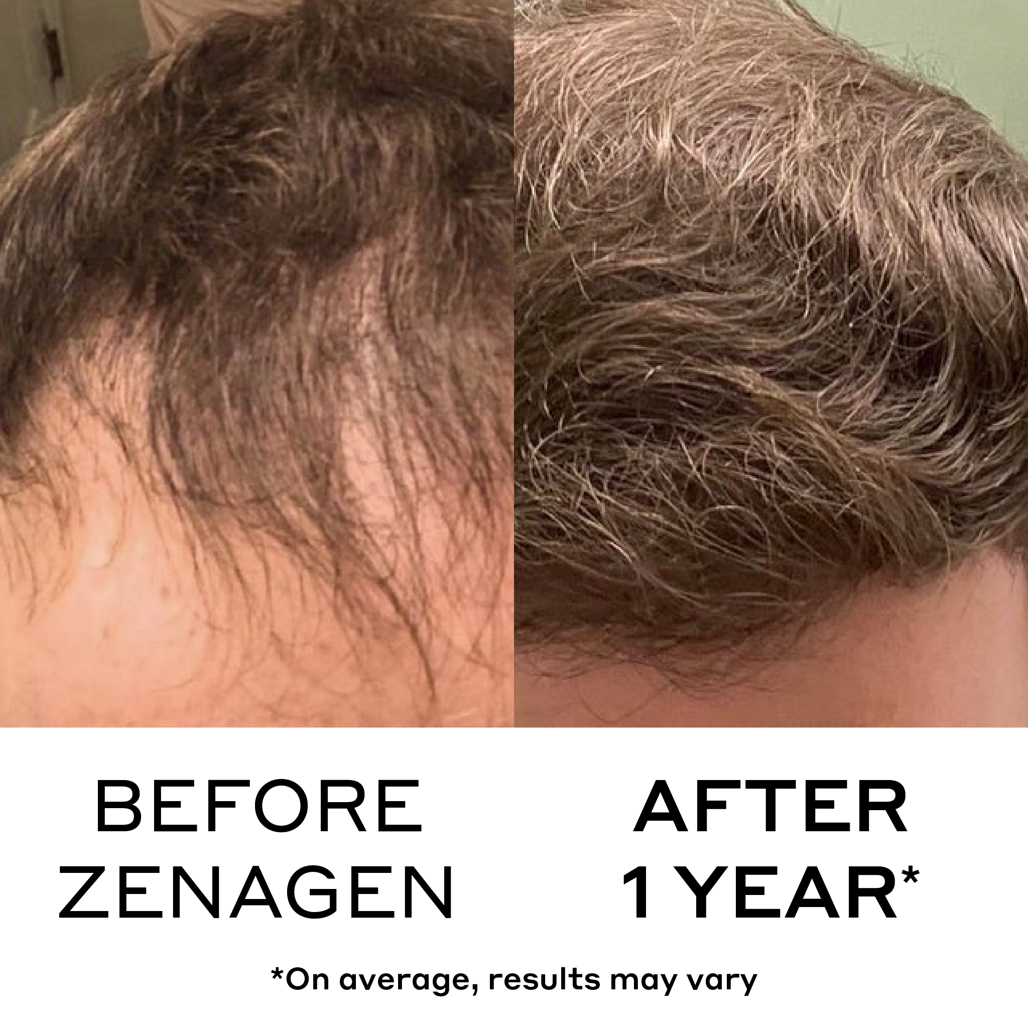 before and after showing reduced  men's hair loss and thinning results from zenagen revolve