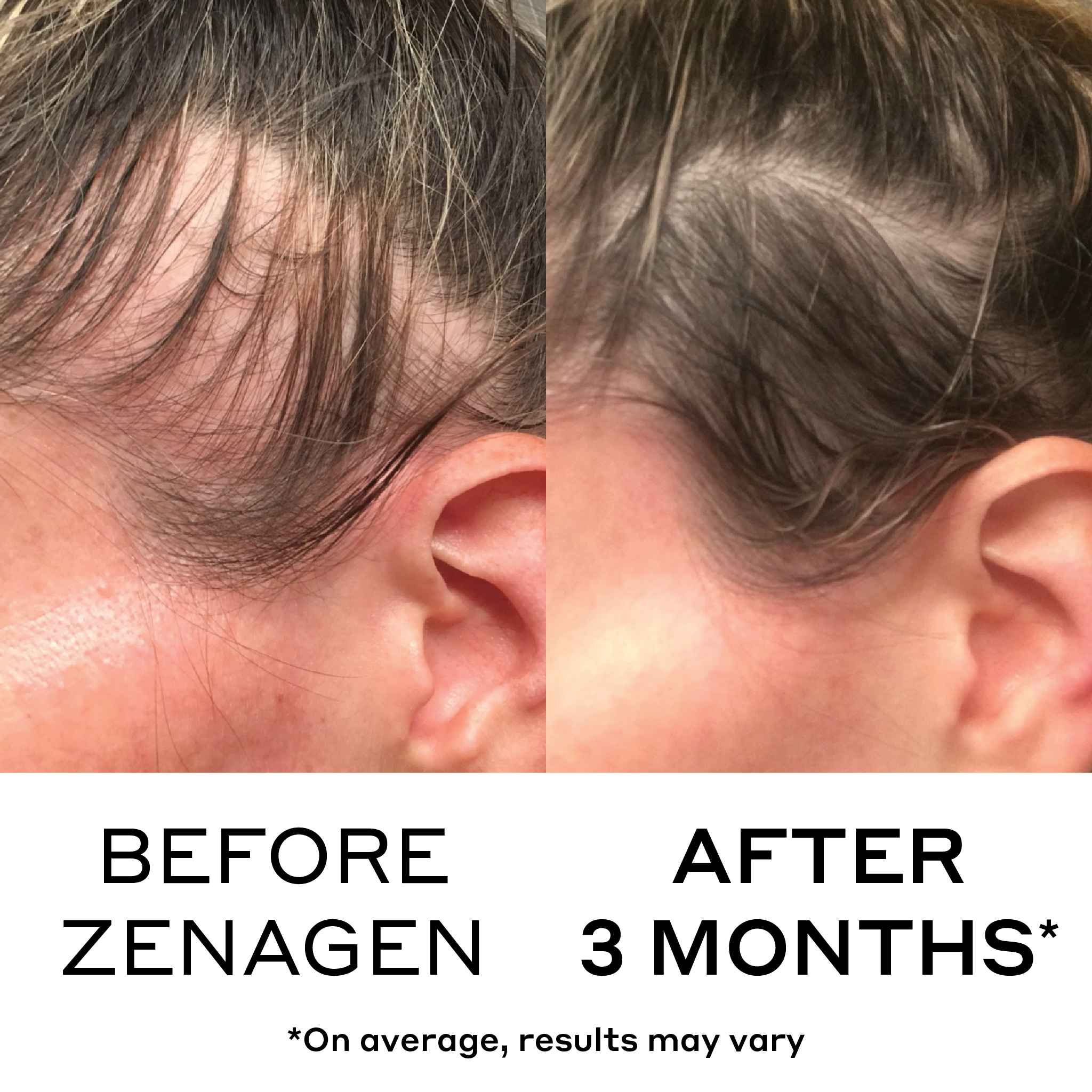 before and after showing reduced hair loss and thinning results from zenagen revolve