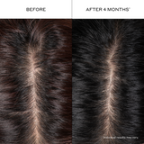 Before-and-after scalp images showing the appearance of fuller, denser-looking hair after using Zenagen Densifying Hair Serum for 4 months. Individual results may vary.
