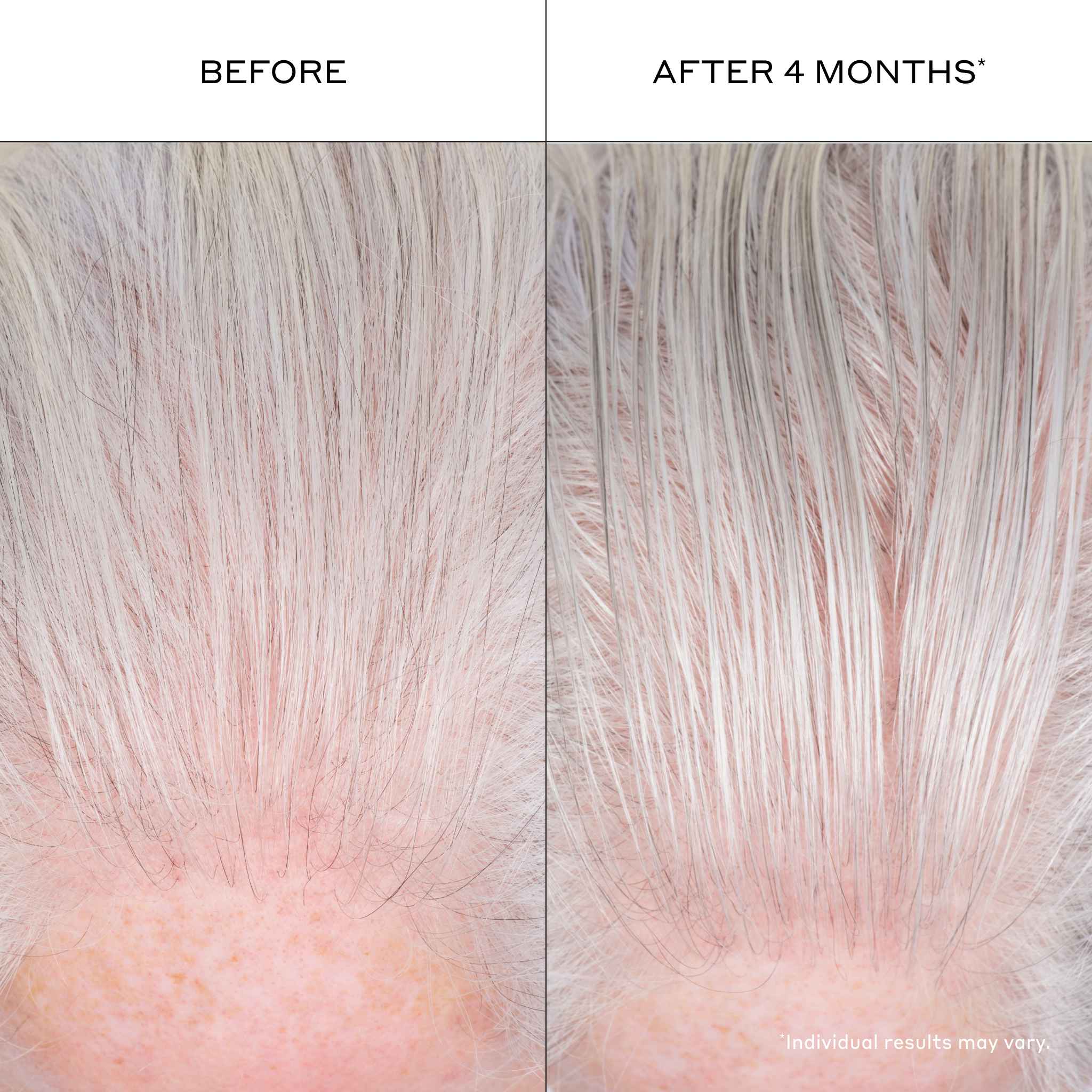 Before-and-after results showing fuller-looking, thicker-looking hair and improved hair density appearance with continued use of Zenagen Densifying Hair Serum.
